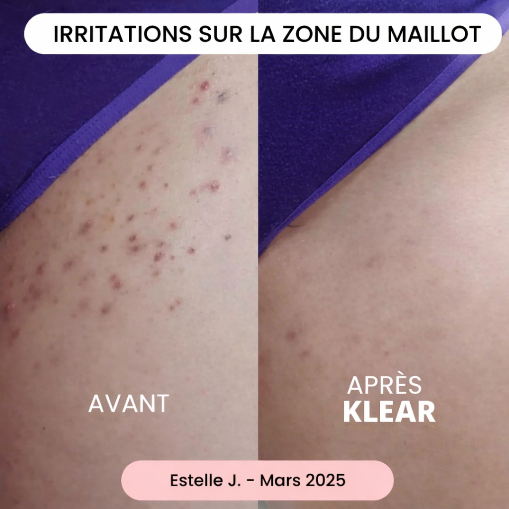 La solution douce pour toutes les zones sensibles