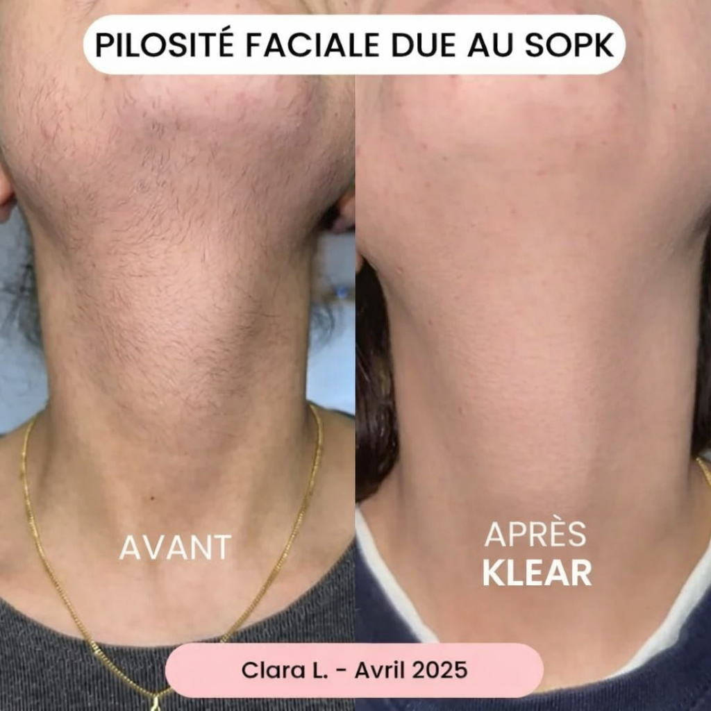 La solution douce pour toutes les zones sensibles