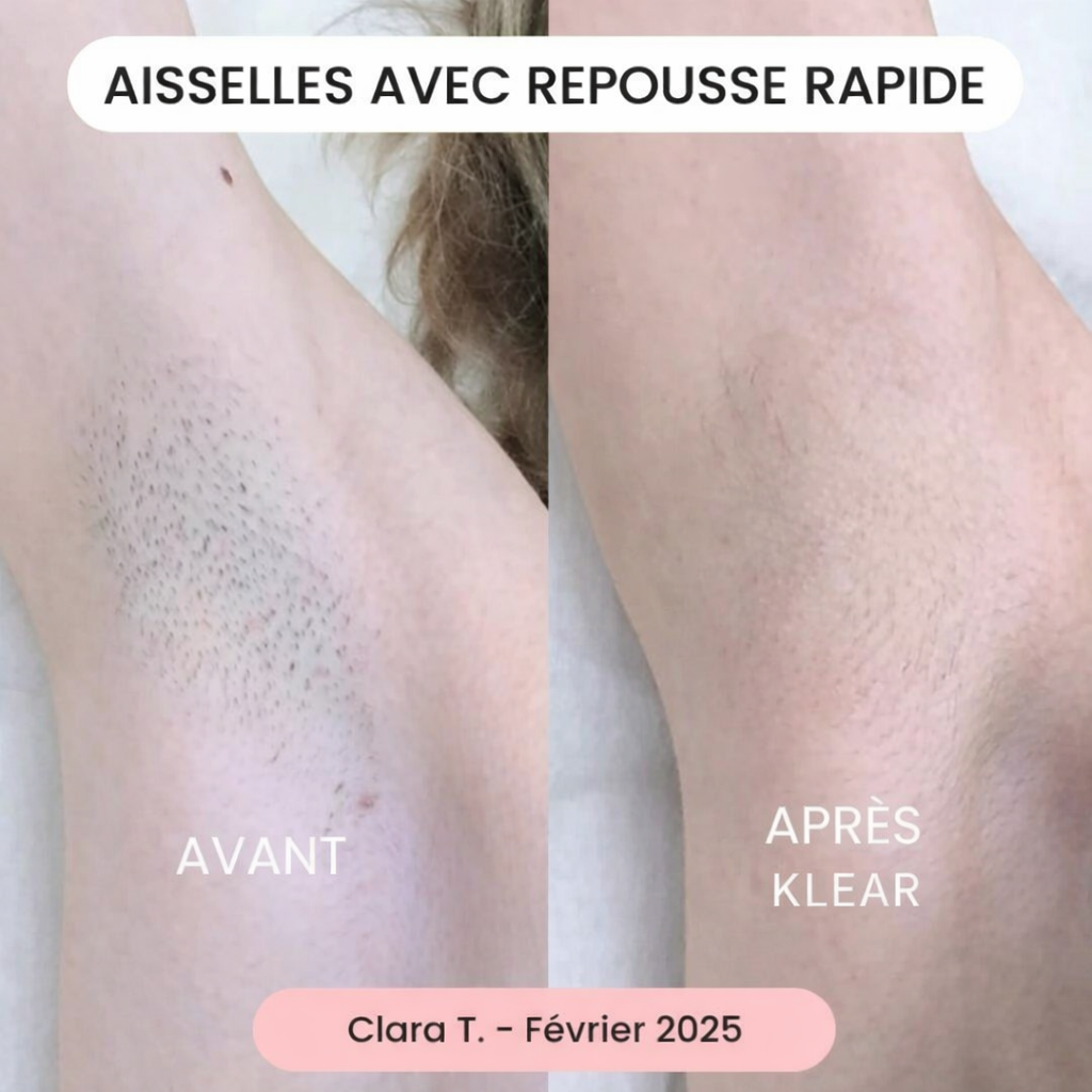 La solution douce pour toutes les zones sensibles