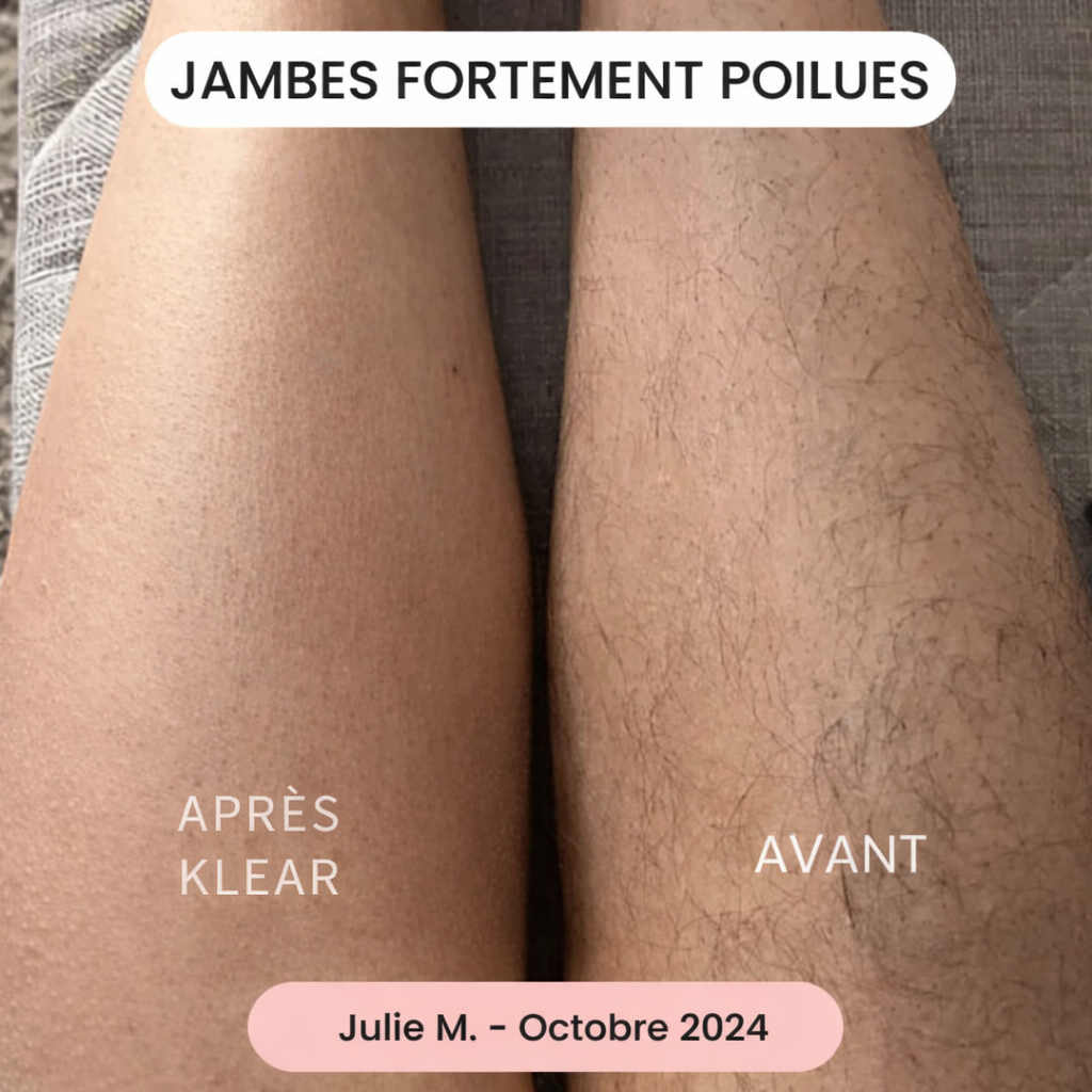 La solution douce pour toutes les zones sensibles