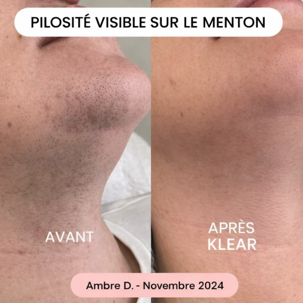 La solution douce pour toutes les zones sensibles