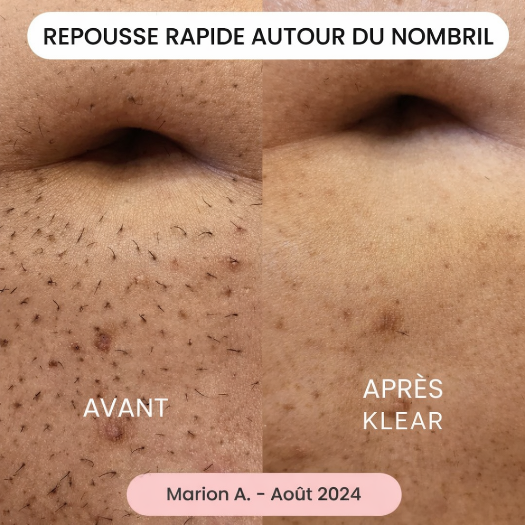 La solution douce pour toutes les zones sensibles