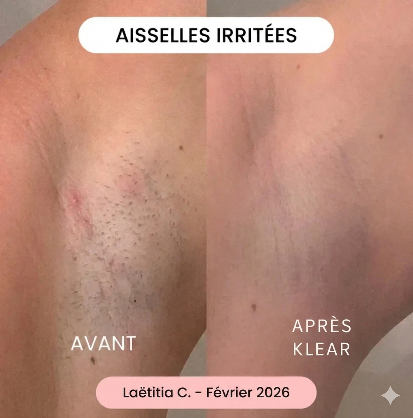 La solution douce pour toutes les zones sensibles